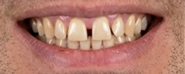 Antes